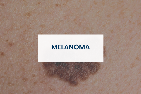 Melanoma